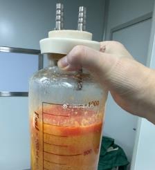 杭州水动力吸脂手术要做多久？